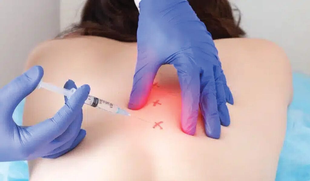 Trigger Point Injection near the spine