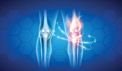 Corticosteroid Injections for Osteoarthritis