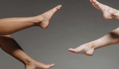 Varicose Veins – what are they and how can they be treated?