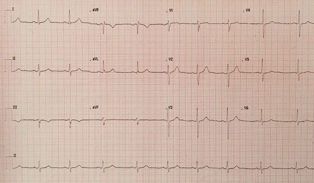 Electrocardiogram (ECG)