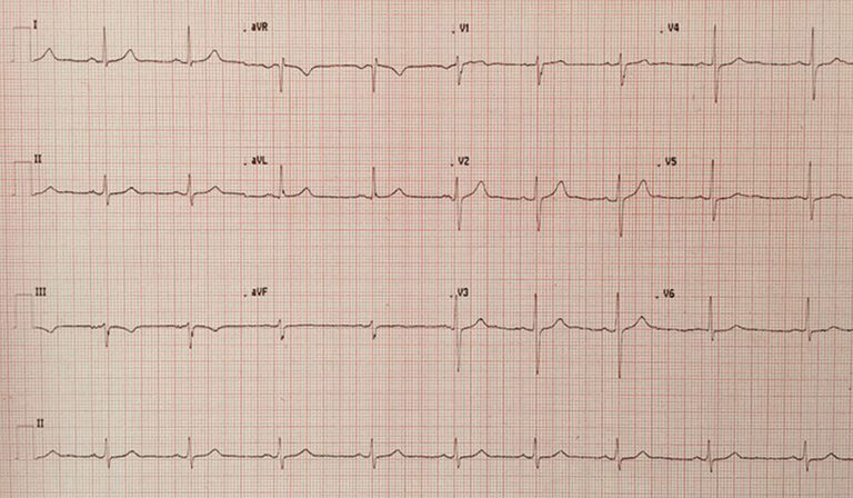 Electrocardiogram (ECG)