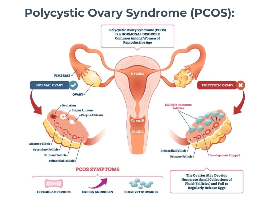 Polycystic Ovary Syndrome (PCOS):
