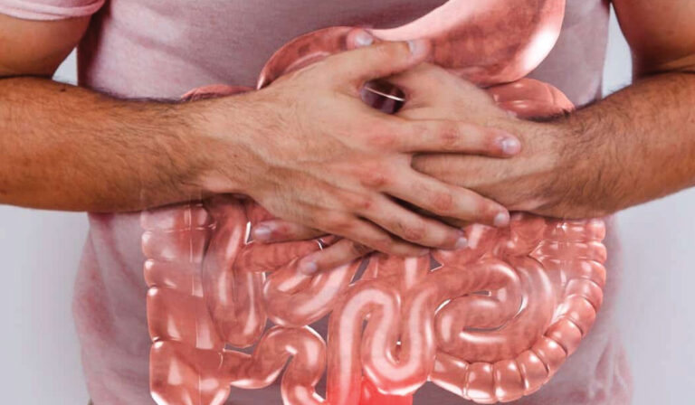 Small Intestinal Bacterial Overgrowth