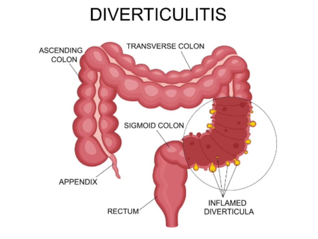 diverticulitis