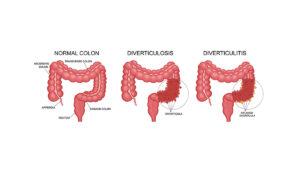 diverticulitis