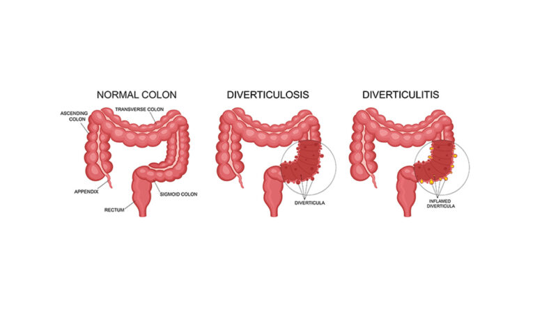 diverticulitis