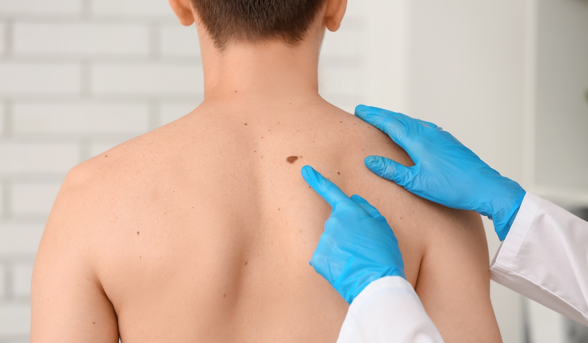 mole removal appointment