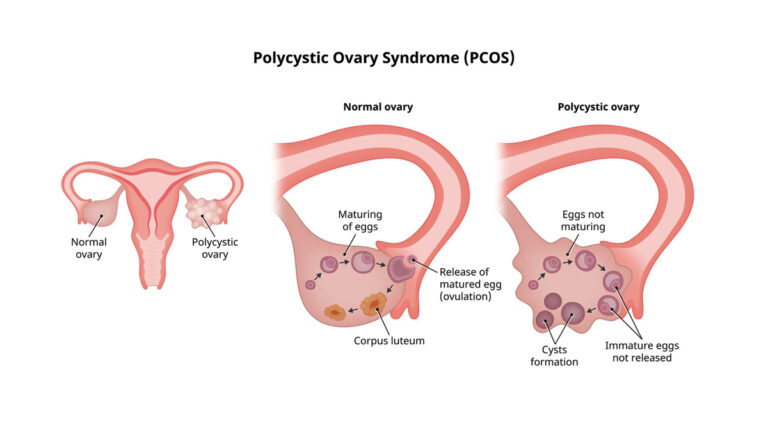 polycystic ovary syndrome