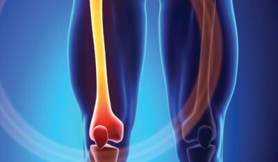 Pain and Bone Health: Understanding and Managing Discomfort