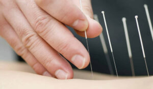 Acupuncture Leicester.jpeg