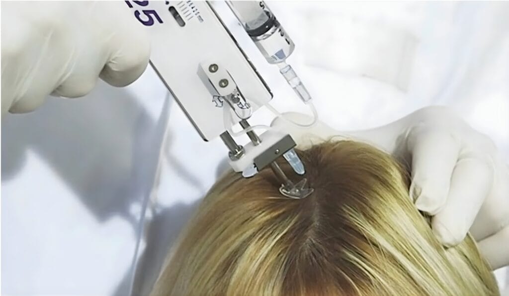 Advanced Platelet-Rich Plasma (PRP) Therapy for Hair Loss in Leicester