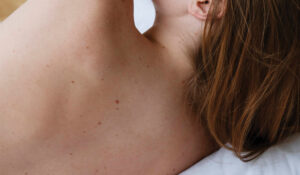 Cryotherapy Treatment in Leicester
