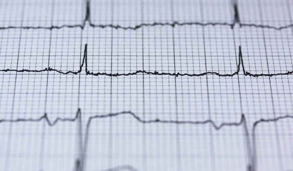 ECG (Electrocardiogram) in Leicester