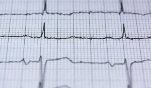 ECG (Electrocardiogram) in Leicester