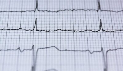 ECG (Electrocardiogram)