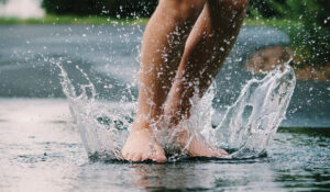 Varicose Veins Removal Leicester