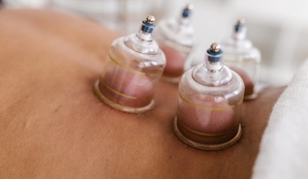 dry cupping therapy Leicester