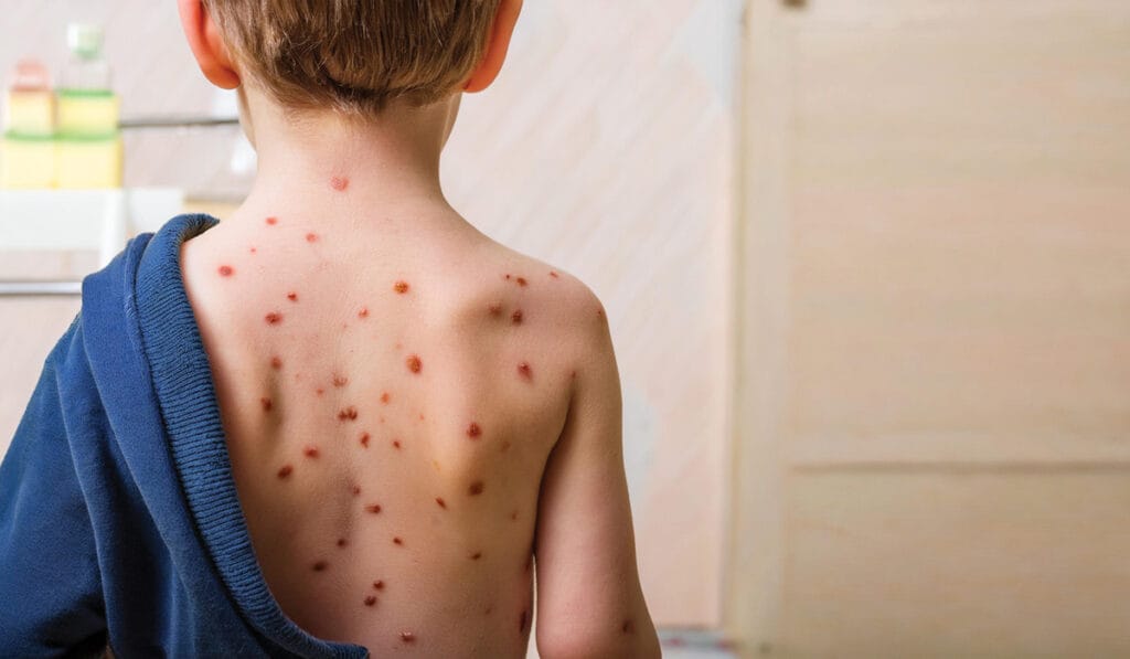 chickenpox vaccinations in Leicester