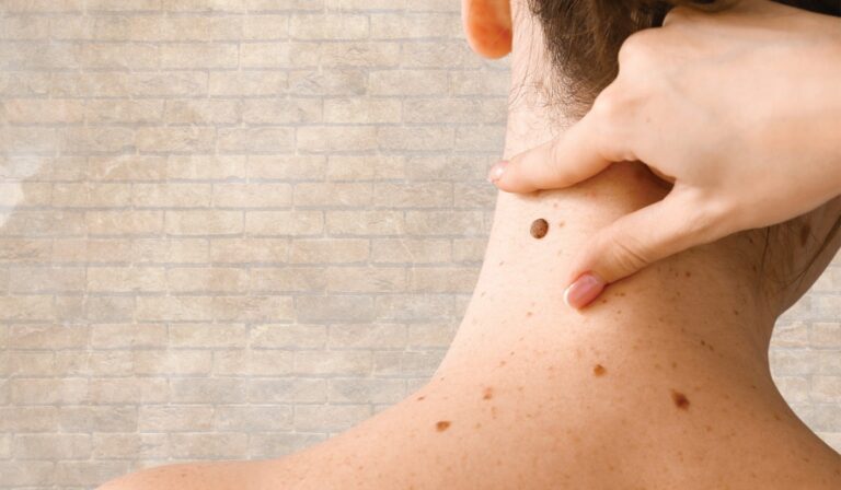 Seborrheic Keratosis Treatment Leicester