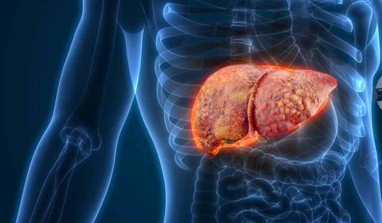 fibroscan of Liver Fibrosis Leicester