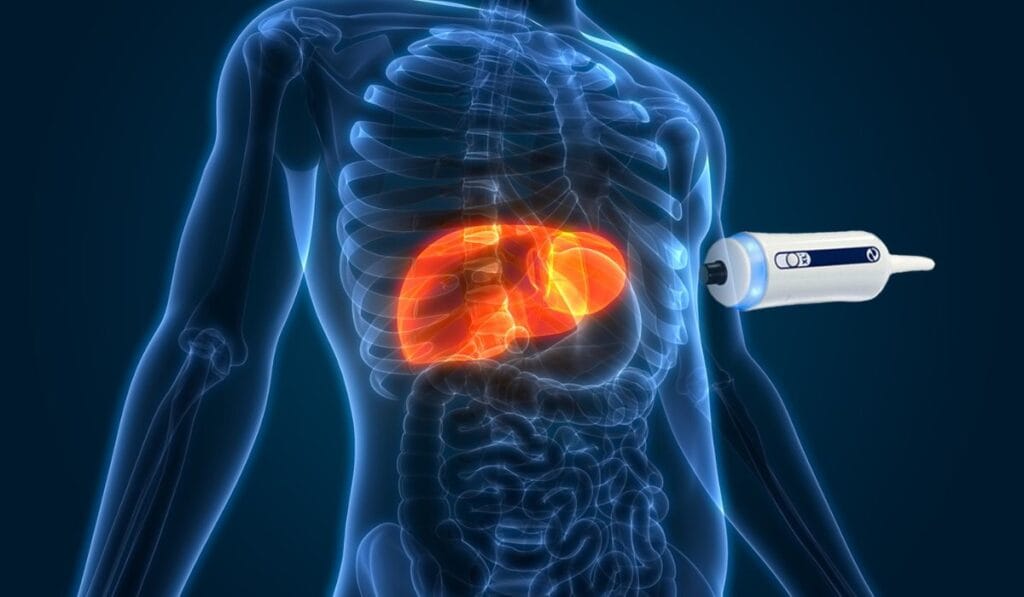 fibroscan of liver Leicester