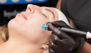 Microneedling in Leicester