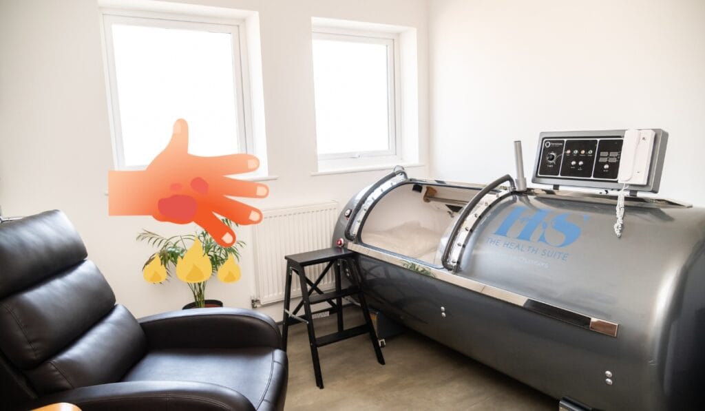 Burns and Hyperbaric Oxygen Therapy