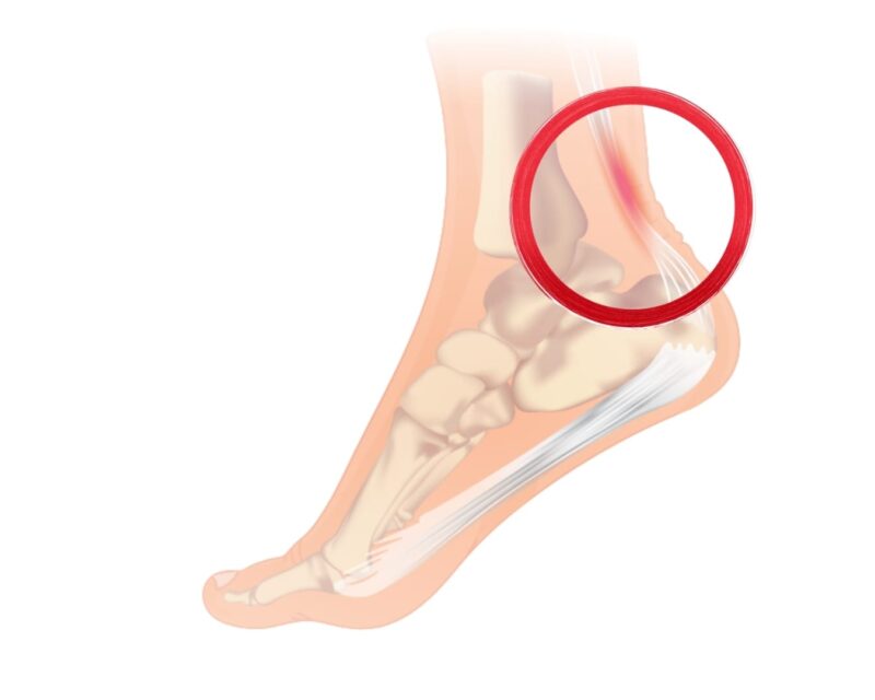 Achilles Tendinitis