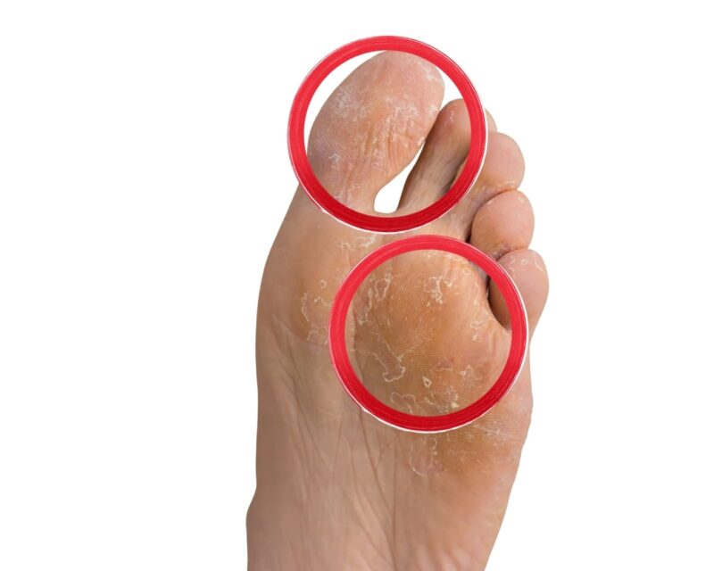 Athlete's Foot