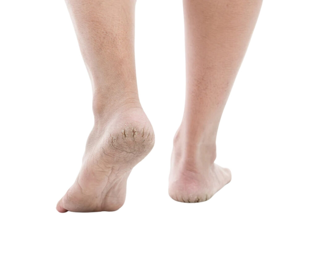 Calluses, Corns or Cracked Heels