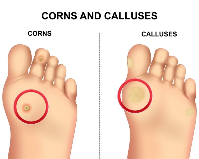 Corns and Calluses