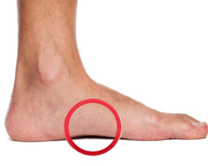 Flat Feet & Fallen Arches