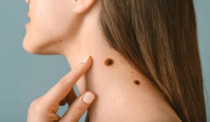 Mole Mapping in Leicester