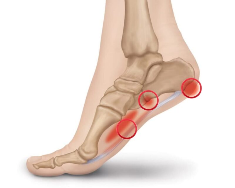 Plantar Fasciitis (1)