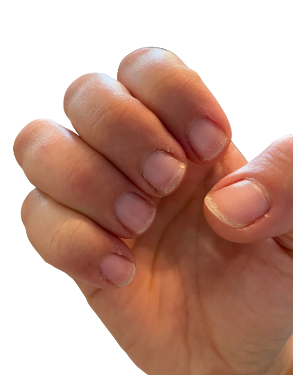 Brittle Nails