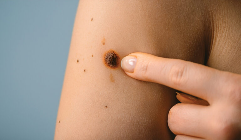 Mole Mapping Leicester