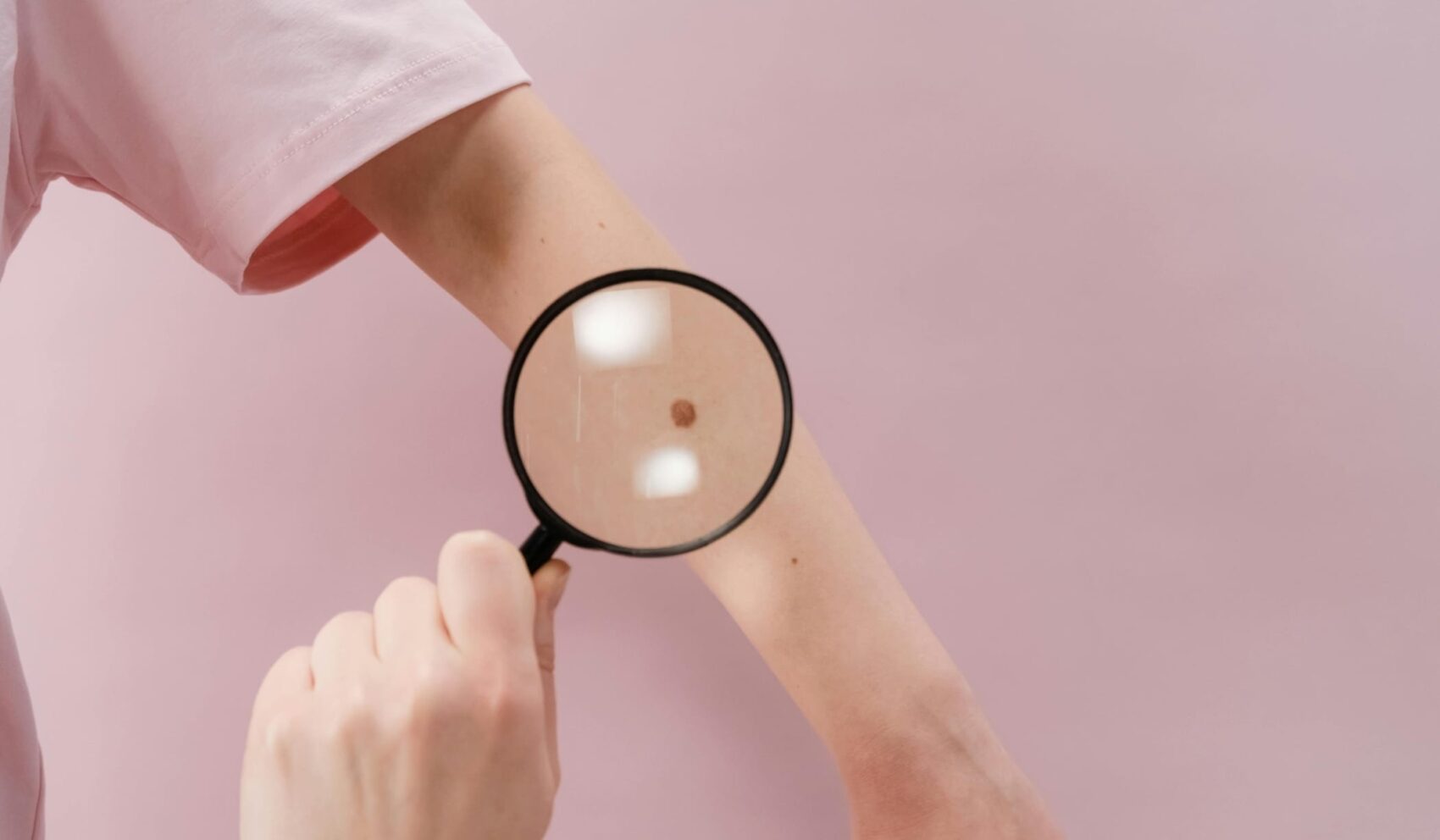 Skin Lesion Photography and Mole Check in Leicester