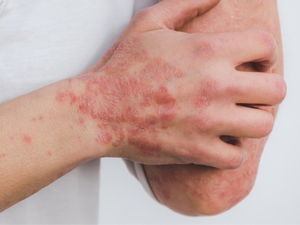 gut health and skin conditions