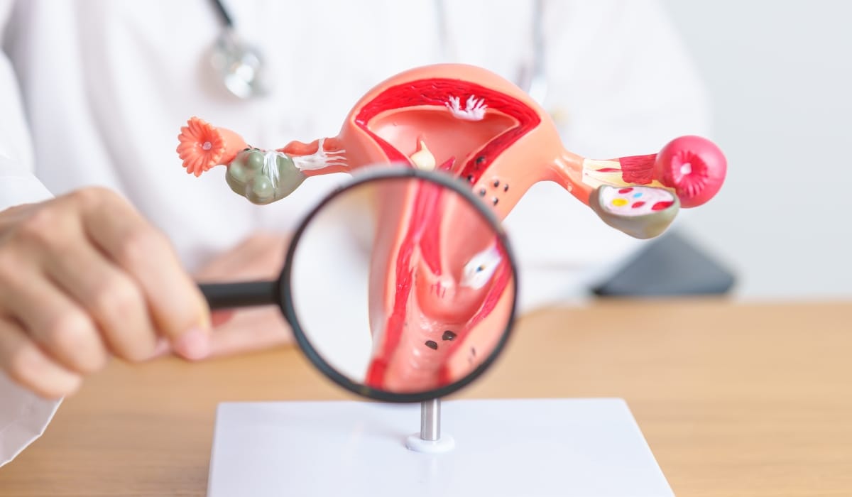 Endometriosis Management in Leicester