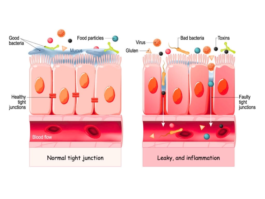 Leaky Gut Syndrome: Real Diagnosis or Wellness Hype?