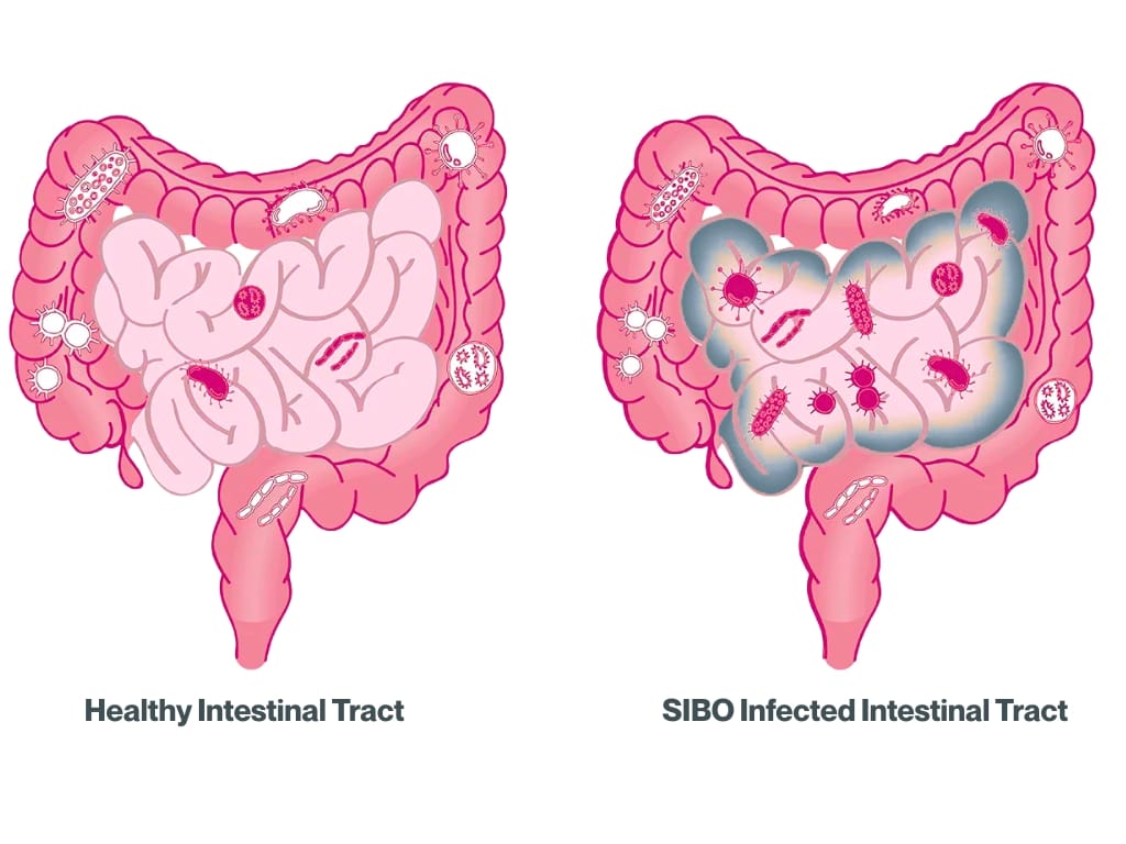 Small Intestinal Bacterial Overgrowth