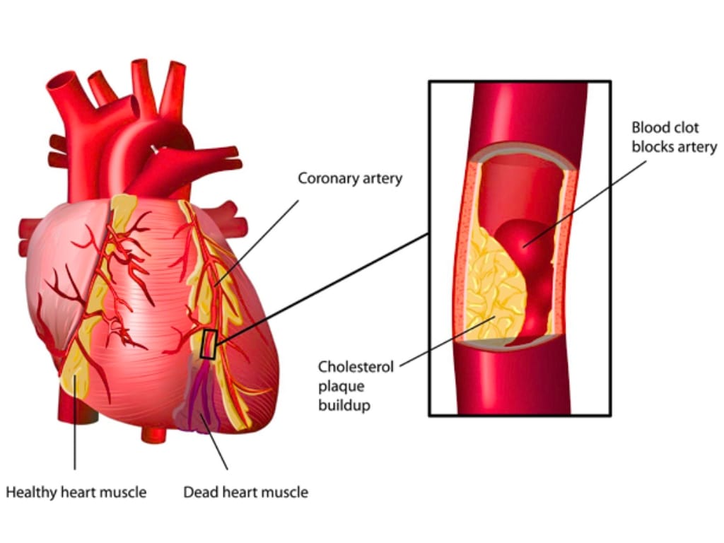 cardiovascular disease