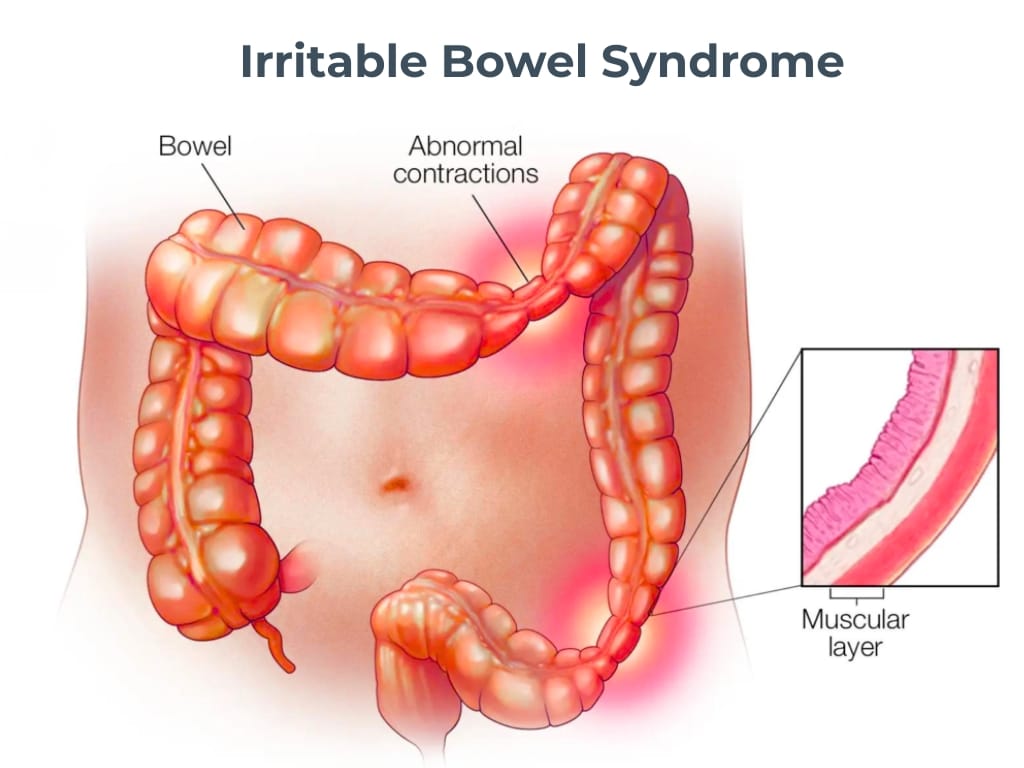 irritable bowel syndrome