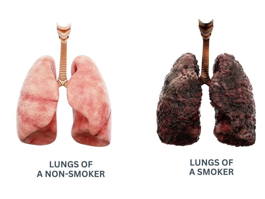 lungs of a smoker and non smoker