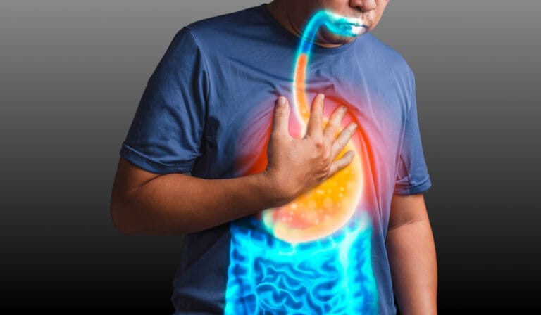 Acid Reflux A Nutritionist's Guide to Managing GERD (GORD)