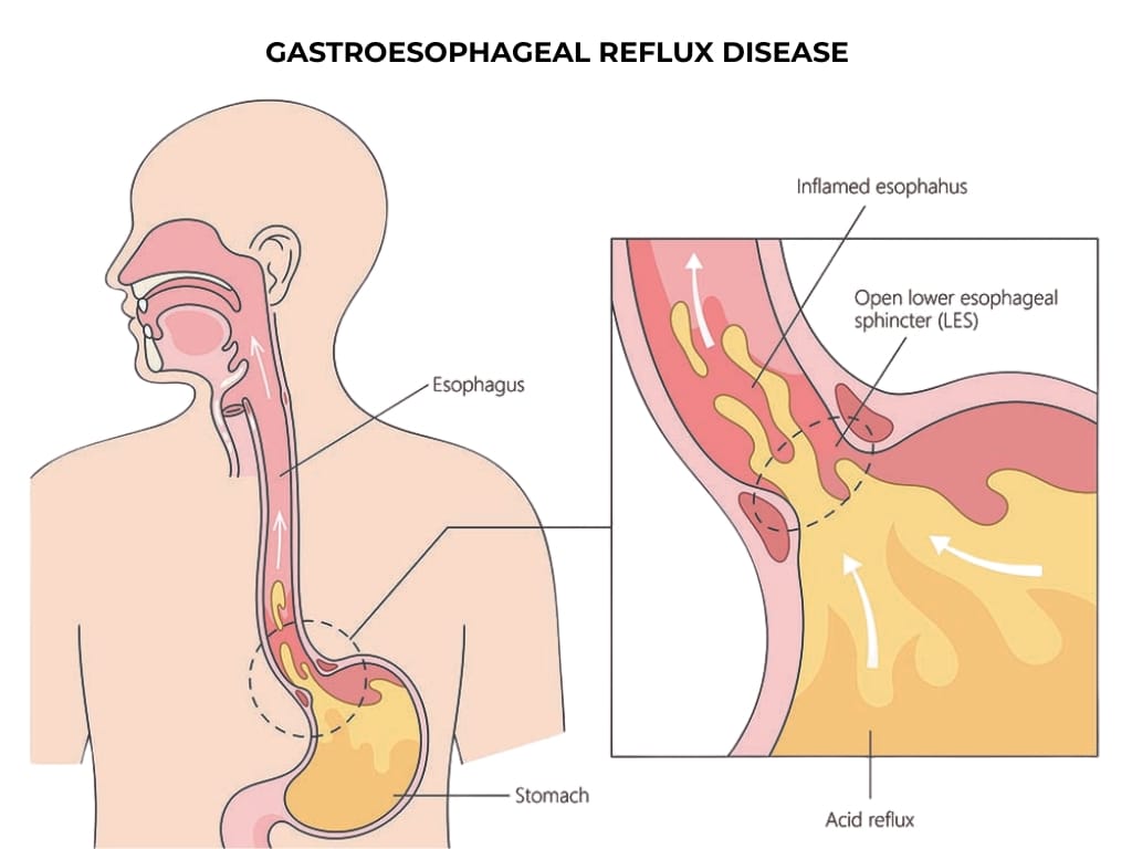 Gastroesophageal reflux disease