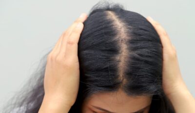 PRP vs Traditional Hair Loss Treatments: Where the U225 Meso Gun Fits In