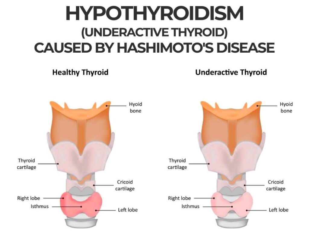 Underactive Thyroid and Hashimoto’s