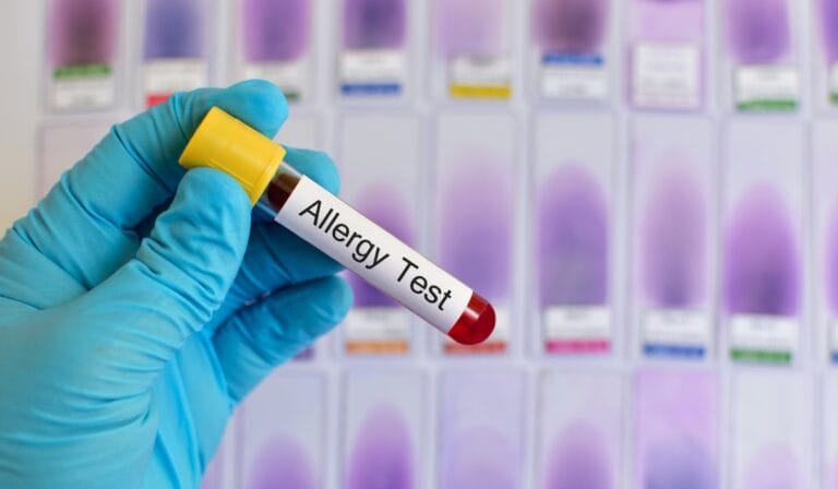 ALEX² Molecular Allergy Blood Testing in Leicester