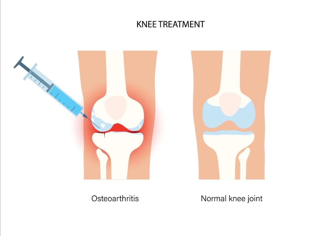 Hyaluronic Acid and Joint Function